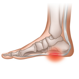 plantar fasciitis